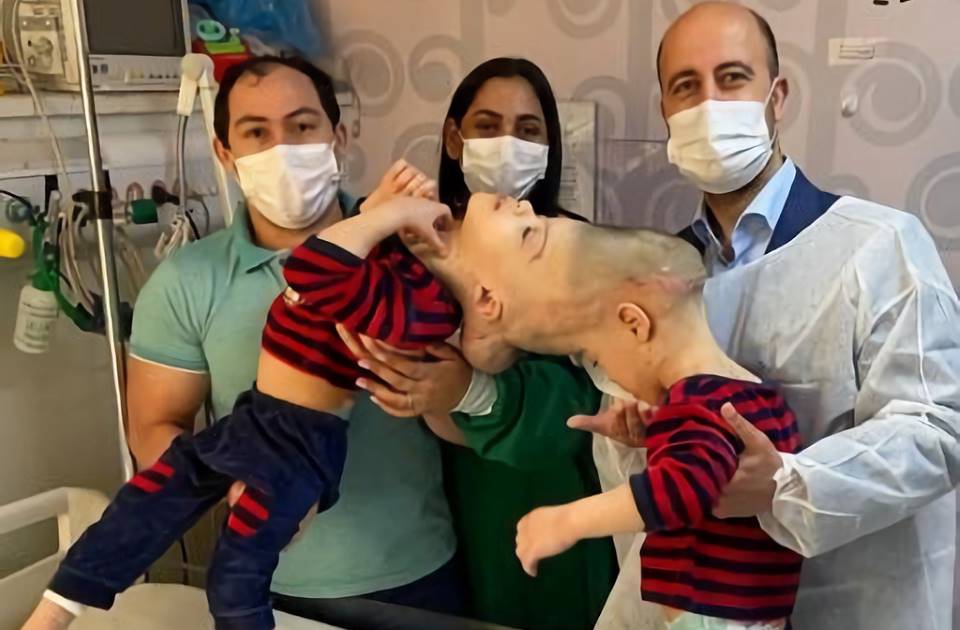 foto colorida de gemeos brasileiros unidos pelo cranio